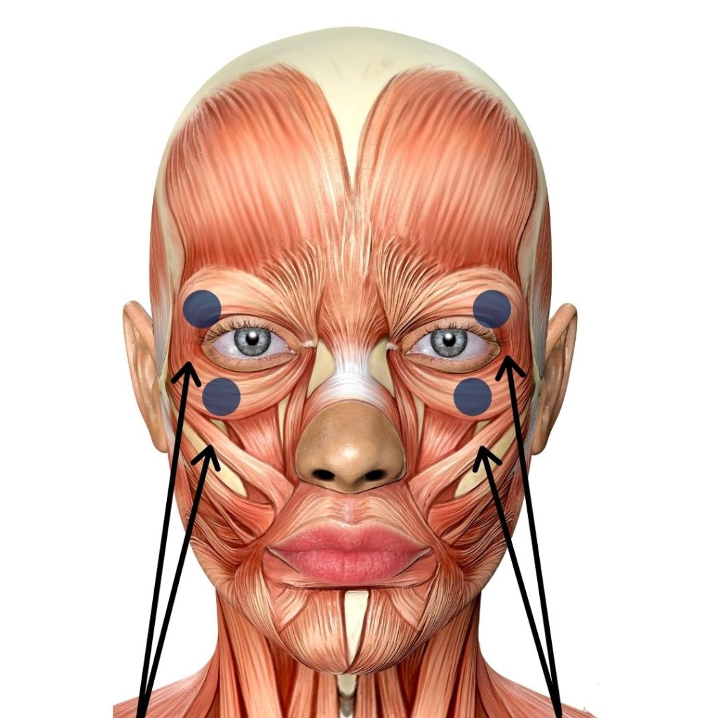 Orbicularis Oculi Trigger Point