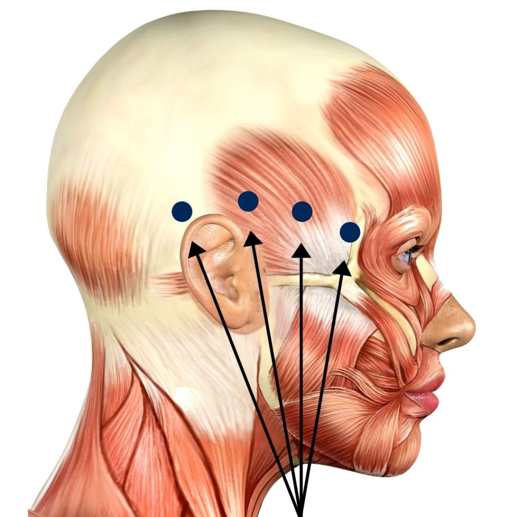 Temporalis Trigger Points