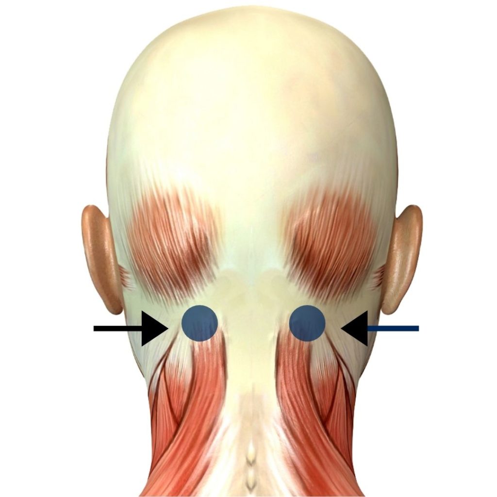 Suboccipital Trigger Points located at the base of the skull and top of the neck